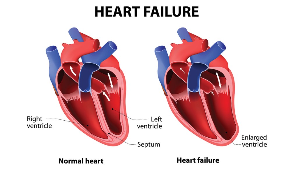 Early Signs of Heart Failure in Adults How Can We Control It Immediately